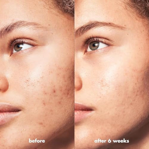 e.l.f. SKIN Blemish Breakthrough Clarifying Cleanser, Gel Cleanser For Removing Makeup, Controlling Oil & Clarifying Pores, 1% Salicylic Acid