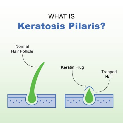 KP+Elements Keratosis Pilaris Cream