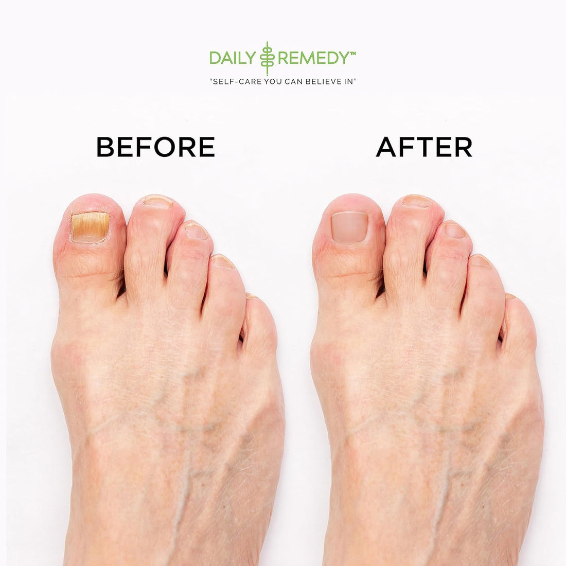 EXTRA STRENGTH Tea Tree Oil Foot Soak with Epsom Salt - Made in USA - for Toenails, Athlete's Foot, Itchy Feet, Stubborn Smelly Foot Odor, Pedicure, Foot Calluses & Soothes Sore Tired Achy Feet-2 Pack