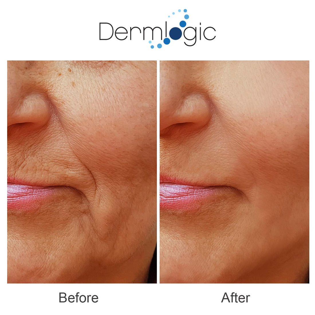Dermlogic Anti Aging Resurfacing Peel Pads-Triple Action Chemical Peel Pads Combined With Glycolic, Lactic, And Salicylic Acids. Smooth'S Fine Lines, Wrinkles, Dark Spots, And Imperfections