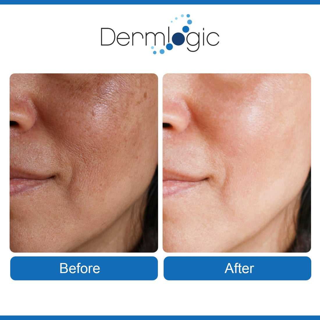 Dermlogic Anti Aging Resurfacing Peel Pads-Triple Action Chemical Peel Pads Combined With Glycolic, Lactic, And Salicylic Acids. Smooth'S Fine Lines, Wrinkles, Dark Spots, And Imperfections