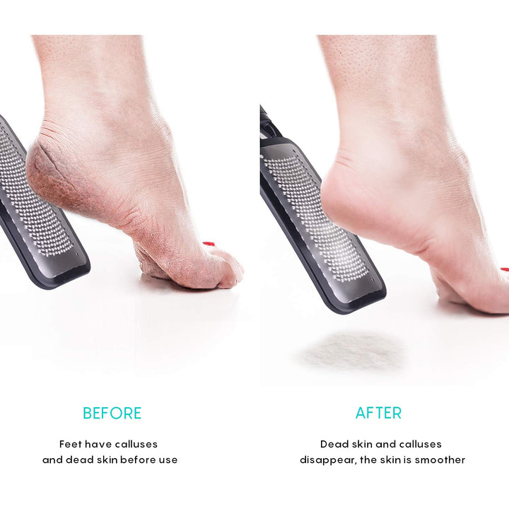 Foot Scrubber Pedicure Tools Rasp - 5 PCS KENED Foot File Callus Remover For Feet To Remove Hard Skin - 2 X Stainless Steel Black, 3 X Plastic Blue
