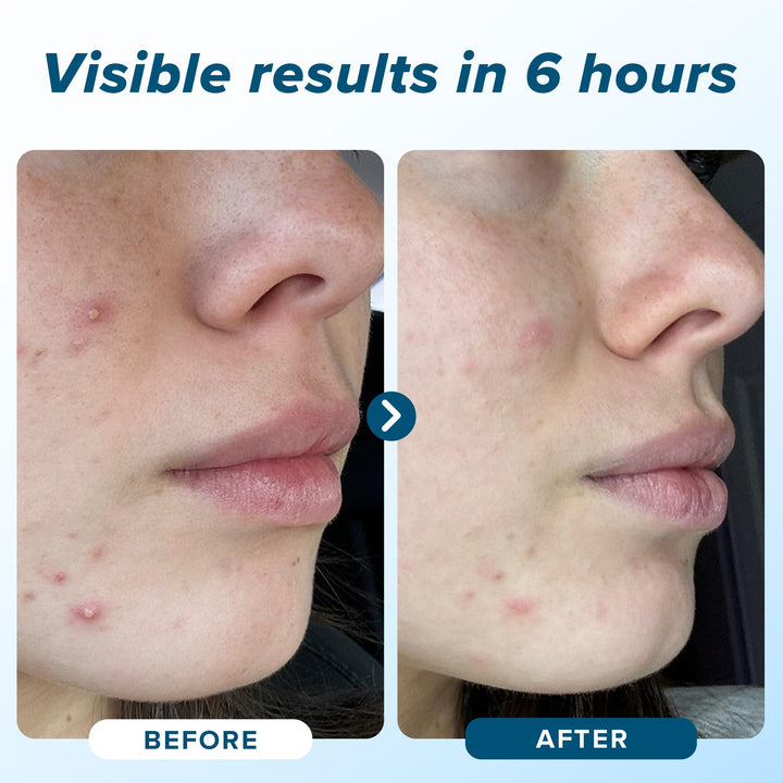 Hydrocolloid Pimple Patches (Made in Korea) FSA/HSA Eligible - Vegan, Hypoallergenic, Cruelty-Free Acne Circle Stickers for Overnight Use, for Zits, Spots, Pimples, Whiteheads (46 Count, Mixed Sizes)