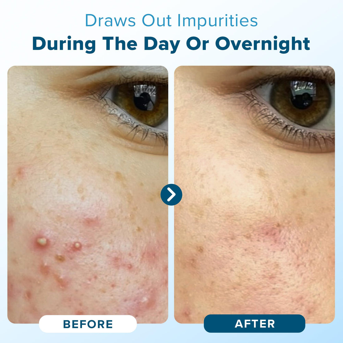 Hydrocolloid Pimple Patches (Made in Korea) FSA/HSA Eligible - Vegan, Hypoallergenic, Cruelty-Free Acne Circle Stickers for Overnight Use, for Zits, Spots, Pimples, Whiteheads (46 Count, Mixed Sizes)