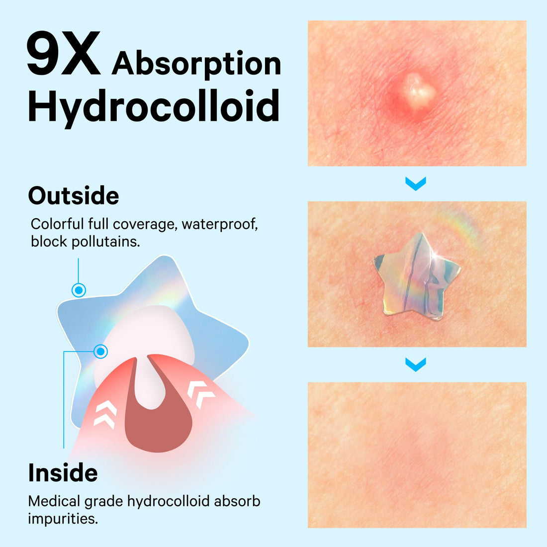 Sosky Hologram Pimple Patches for Face, Hydrocolloid Acne Patches with Salicylic Acid, Cute Star Zit Stickers,Colorful Blemish Covers,36 Count Blue Star Cloud Butterfly