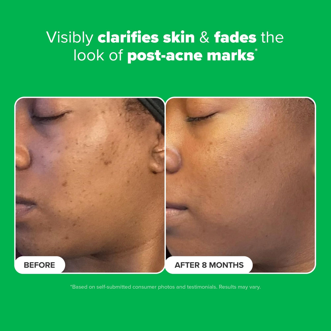 Paula's Choice BOOST 10% Azelaic Acid Booster Cream Gel, Licorice Extract & Salicylic Acid, Oil-Free Skin Brightening Serum, 1 Ounce