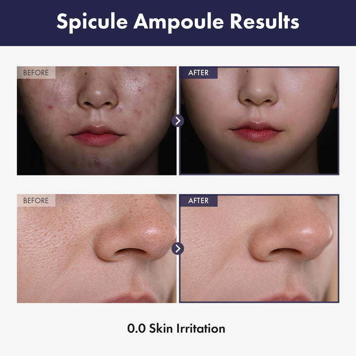 TOSOWOONG Real Spicule Ampoule with 30,000 Shots, Niacinamide, Panthenol, Liquid Skin Booster Serum, Pore Minimizer, Exfoliating, Dead Skin Cells, Skin Texture, Korean Skincare, 30ml, 1.01 fl. oz.