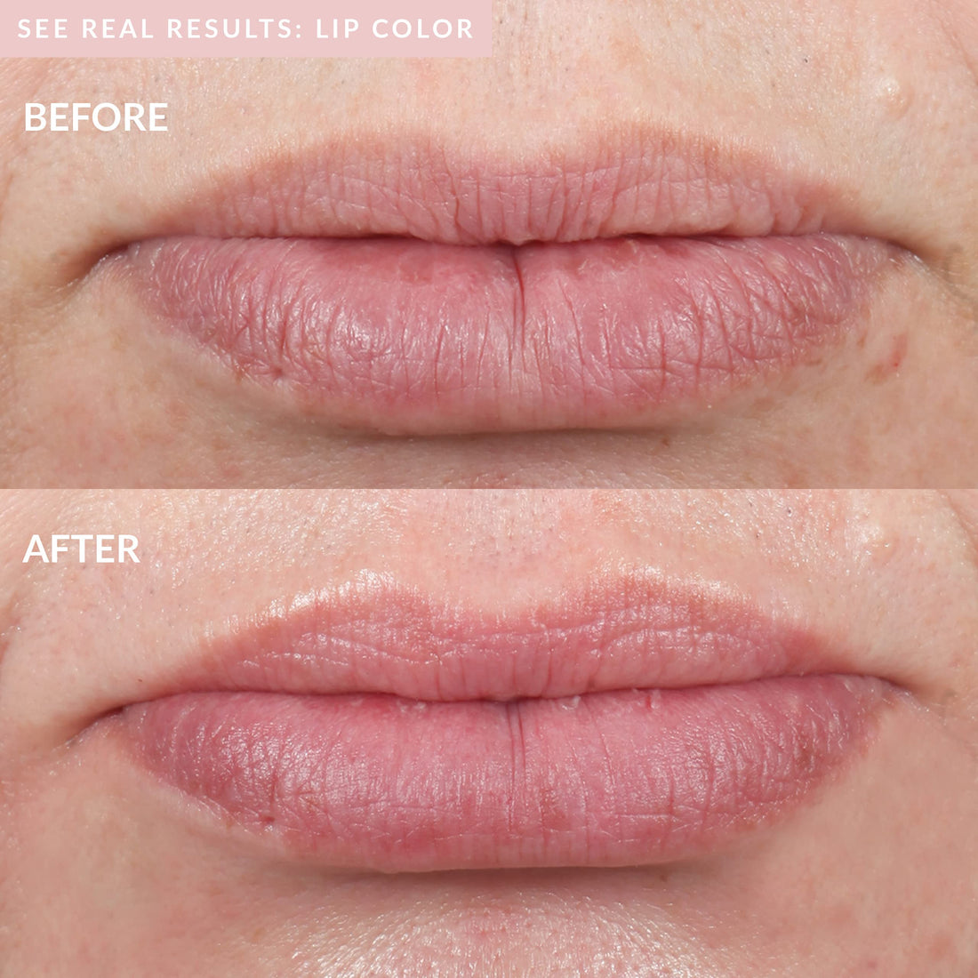 PMD Kiss Lip Plumping System - Smart Anti-Aging Lip Plumping Treatment - Pulsating Vacuum Technology for Fuller, More Youthful Lips