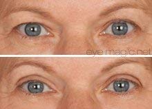 EyE-4-EyE Eye Magic Instant Eye Lift