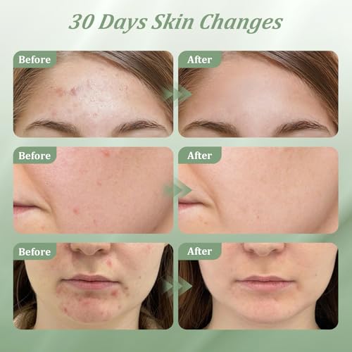 Bablabear 2% Salicylic Acid Acne Treatment Cream for Face Back/Butt/Body,Spot Treatment for Pimples,Face Blemishes,Blackheads,Oil Control,Ingredients are Natural,Suitable for Teenagers/Women/Men(30g)