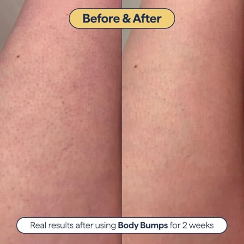 Remedy for Body Bumps – Treatment for Keratosis Pilaris (KP) and Textured, Crepey Skin with Urea, Lactic Acid, and Retinol -– Smoothing Body Moisturizer Lotion – By Dermatologist Dr. Shah