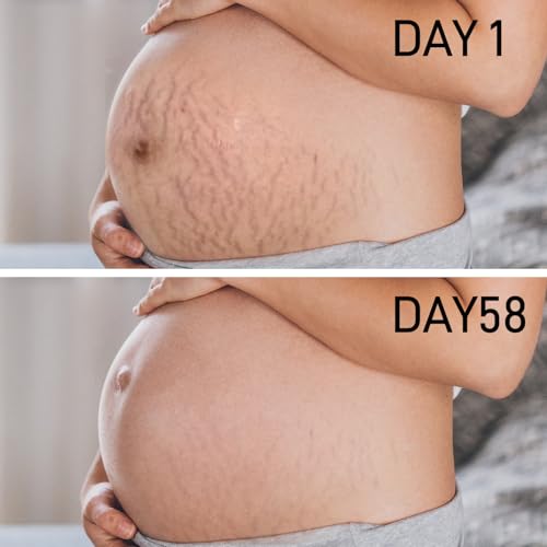 PEGO Stretch Mark Oil for Pregnancy, Maternity Body Oil for Stretch Mark Prevention & Reduction, Hydrating Skin Care, 4.06oz (2Pack)