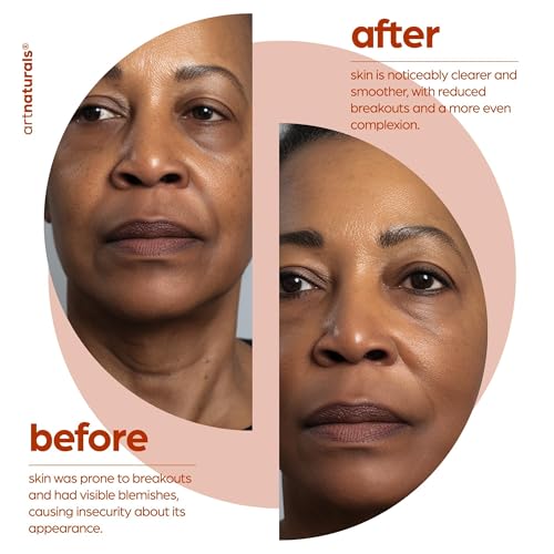 artnaturals Salicylic acid Serum - Advanced Serum with 2% BHA - Helps control oil production- Pore Reducer - 1 oz