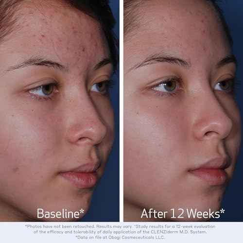 Obagi CLENZIderm M.D. Daily Care Foaming Acne Cleanser – Acne Treatment with 2% Salicylic Acid (BHA) – 4 oz