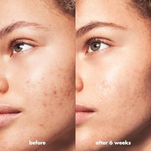 e.l.f. SKIN Blemish Breakthrough Calming Water Cream, Lightweight Blemish-Fighting Face Moisturiser, Prevents New Blemishes & Calms Skin