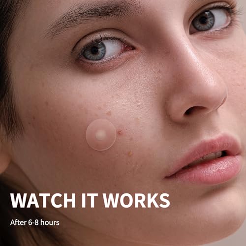 Daolyo Pimple Patches for Face, 4 Size 300 Counts Acne Patches, Hydrocolloid Patches for Covering Zits and Blemishes, Spot Stickers with Salicylic Acid, Tea Tree Oil & Calendula Oil