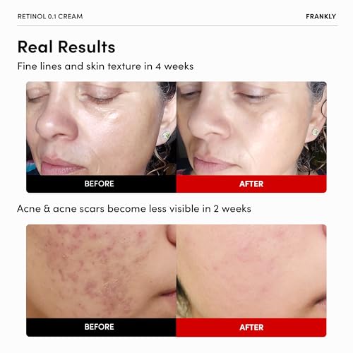 FRANKLY Retinol 0.3% Cream, 0.7 fl oz - Intensive Retinol | Night Cream | Retinol, Ceramides & Natural Ginseng | Anti-aging, Wrinkles Care, Reduces Congestion and hyperpigmentation | Korean Skin Care