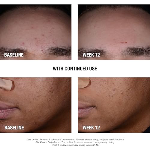 Neutrogena Stubborn Blackheads Daily Acne Facial Serum with Salicylic, Glycolic, Polyhydroxy & Mandelic Acids, Oil-Free Face Serum for Acne-Prone Skin to Help Clear Clogged Pores, 1 fl. oz