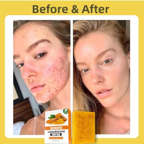 Uselective Kojic Acid & Turmeric Soap Bar for Dark Spot removal - Skin Lightening Soap with Vitamin C, Retinol, Shea Butter & Lemon Oil - for Face, Body, Underarms - SLS Free, for Oily & Dry Skin