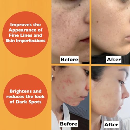 Vitamin C Serum For Face – Anti-Aging Facial Serum with Vitamin C, Hyaluronic Acid, Niacinamide, B5 & Vit E. Brightening Facial Formula for Dark Spots, Fine Lines, Wrinkles & Glowing Skin, 2 Fl Oz