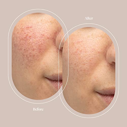 Trophy Skin Microdermabrasion Replacement Filters to Fit The Exfoliating Wands on Devices Including MicrodermMD, RejuvadermMD, and MiniMD