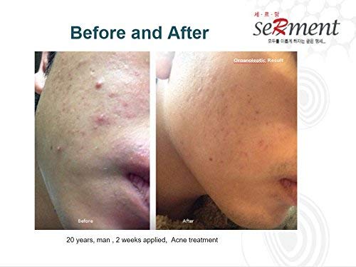 Korean Cosmetics Serment Phytoenzyme Acne Wash Powder , Rich Bubble Face Wash Exfoliation-Hypoallergenic cleanser with Vitamin E for Sensitive Skin, Prevent Acne stripping