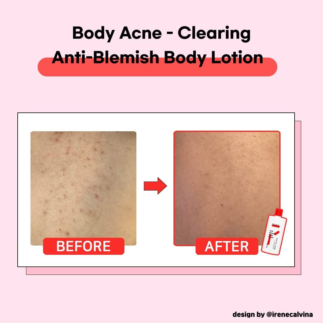 TIA'M TIAM Anti-Blemish Body Lotion, Body Acne Care, Bacne, Great for Fighting Breakouts, 6.76 FL.OZ.
