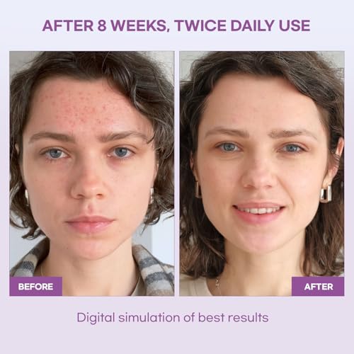 Natural Vine Dark Spot Serum: Dark Spot Remover for Face - Vitamin C Alternative More Effective than Vitamin C with Grape Extract Fermentation Complex Hyaluronic Acid for Brighter Even Skin Tone 30mL