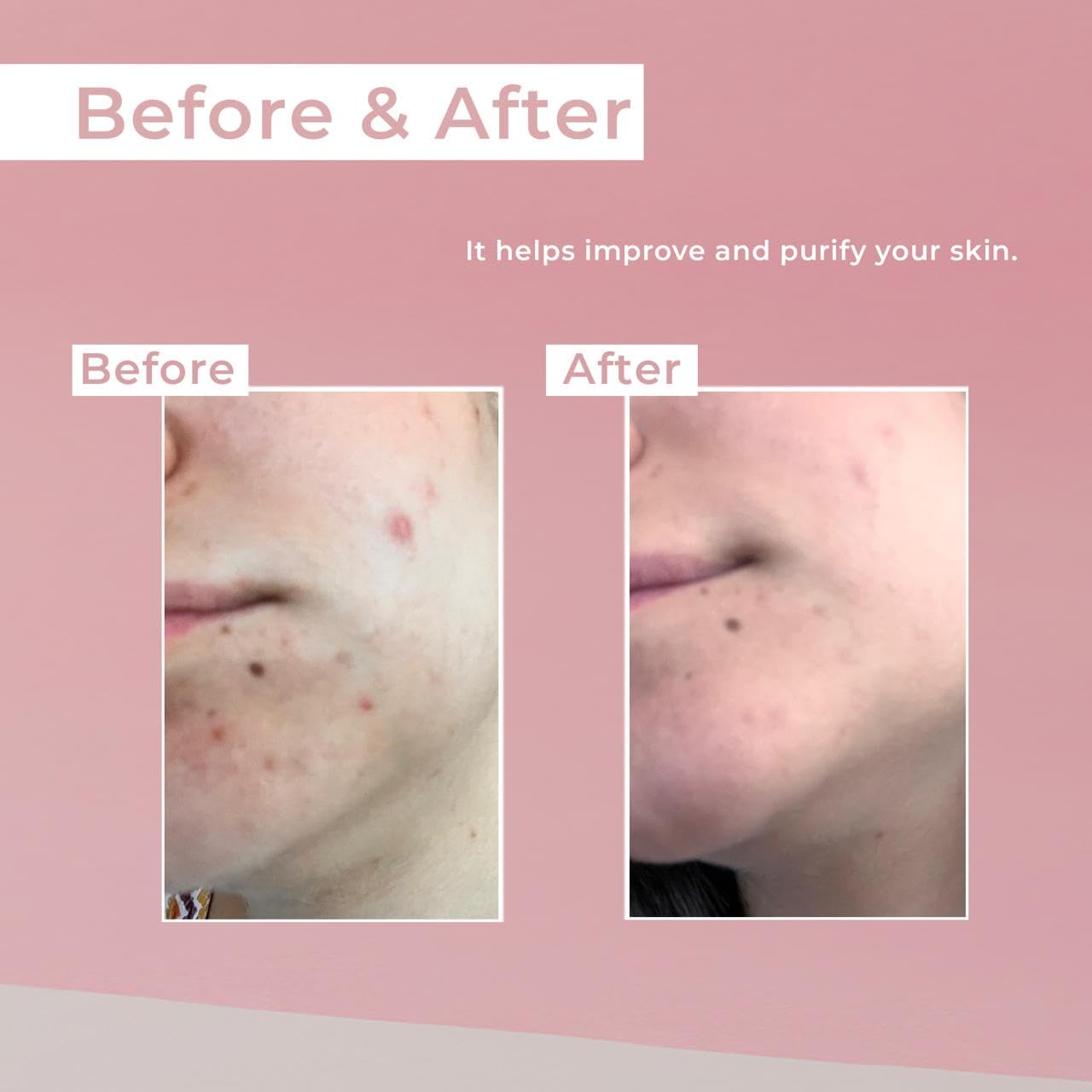 Millford AC On-Spot Cream 30g/1.05 Oz, Zinc Oxide 10%, Niacinamide 2%, Acne Care, Blemish Treatment, Dark Spot, Korean Skincare