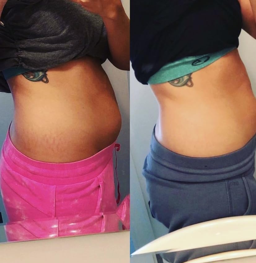 Promise Stretch Mark Prevention Kit, Scars and Dry Skin, Ultra-Hydrating Belly Butter and Bump Oil for Pregnant Women, Vegan, Non-Toxic, Set