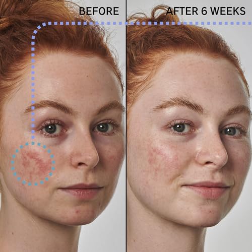 The INKEY List SuperSolutions Azelaic Acid 10% Serum, Fast-Absorbing Formula Helps Reduce Appearance of Redness and Soothes Skin, Leaves No White Cast, 1.01 fl oz