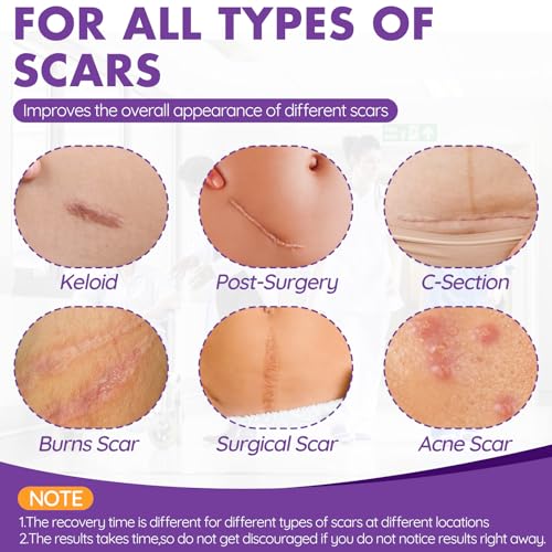 Silicone Scar Sheets, Silicone Scar Tape, Reusable Professional Scar Silicone Strips, Soft Silicone Scar Sheets for Surgical Scars,Keloid,Acne Scars,Burn Scar,C-Section (5M)