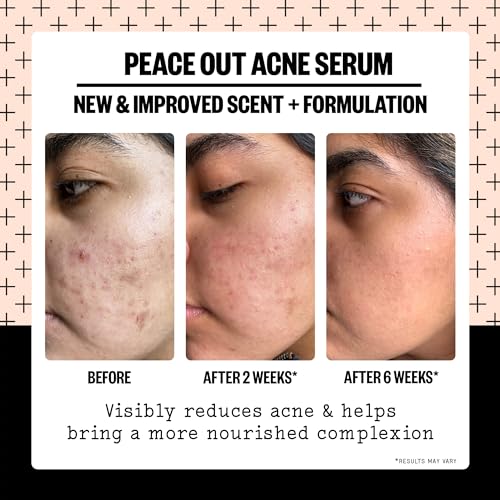 PEACE OUT Skincare Acne Serum. Daily Multi-Benefit Face Serum with 2% Salicylic Acid to Target Pimples, Zits, Blemishes and Breakouts, For Clearer-Looking Skin 1 fl oz