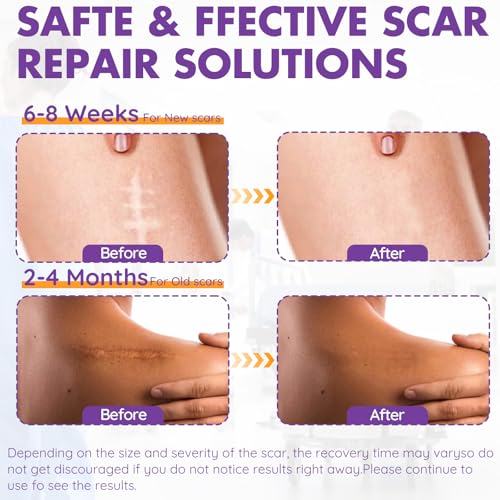 Silicone Scar Sheets, Silicone Scar Tape, Reusable Professional Scar Silicone Strips, Soft Silicone Scar Sheets for Surgical Scars,Keloid,Acne Scars,Burn Scar,C-Section (5M)