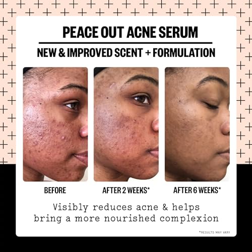 PEACE OUT Skincare Acne Serum. Daily Multi-Benefit Face Serum with 2% Salicylic Acid to Target Pimples, Zits, Blemishes and Breakouts, For Clearer-Looking Skin 1 fl oz