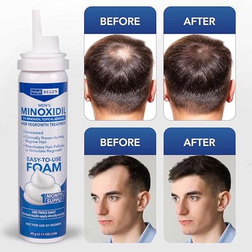 Hair-Regen Men’s 5% Minoxidil Foam – 1-Month Supply for Hair Regrowth – Topical Foam for Thinning Hair & Male Pattern Baldness – Minoxidil for Men