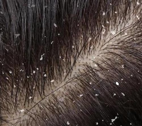 111MedCo 2% PYRITHIONE ZINC Medicated 4oz. Skin Cleansing Soap Bar