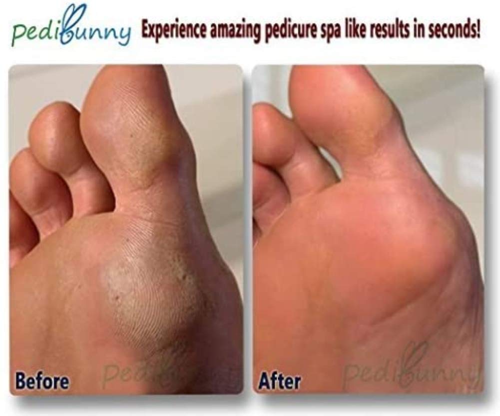 Luxurious Rechargeable Electric Callus Remover-Foot File for Scrubbing Feet,Micro-Pedi Foot Care Tool-Effectively Buffs Away Dead, Hard Skin, Dry Callused Feet and Cracked Heels