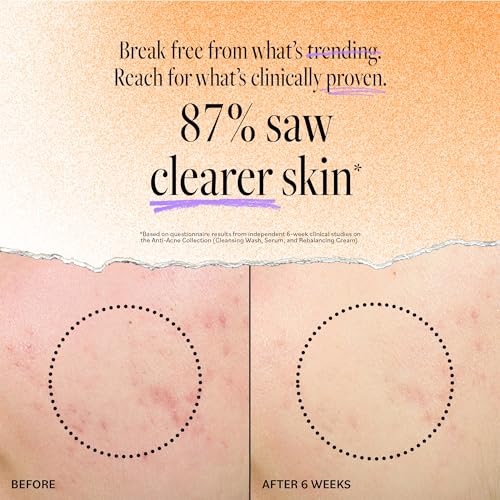 Derma E Acne Deep Pore Cleansing Wash – Blemish Control Facial Cleanser with Salicylic Acid, 6 fl oz