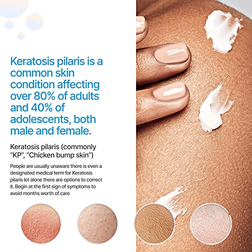 KP Essentials - Keratosis Pilaris Exfoliating Cream - Clear Red Bumps on Thighs and Arms For Confident Clear Skin - 4oz (1 Bottle)