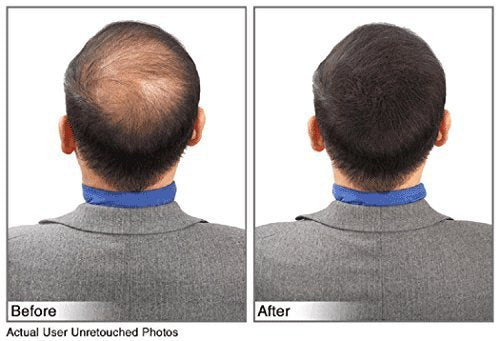 Juveker Hair Building Fibers for Men & Women - 28 Grams (Net Wt .98oz) Dark Brown AD