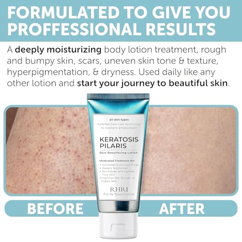 Keratosis Pilaris Treatment | Keratosis Pilaris Lotion | KP Lotion | Gentle Exfoliation For Strawberry Legs, KP & Ingrown Hairs | Smooth & Hydrating Body Lotion For Redness, Dry, Rough And Flaky Skin