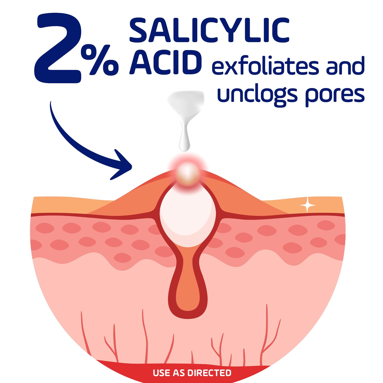 Asepxia Acne Treatment Cream for Face, 2% salicylic acid, Rapid Maximum Strength Acne Treatment, Clears Pimples and Blackheads, Prevents New Acne and Controls Excess Oil, 1 oz