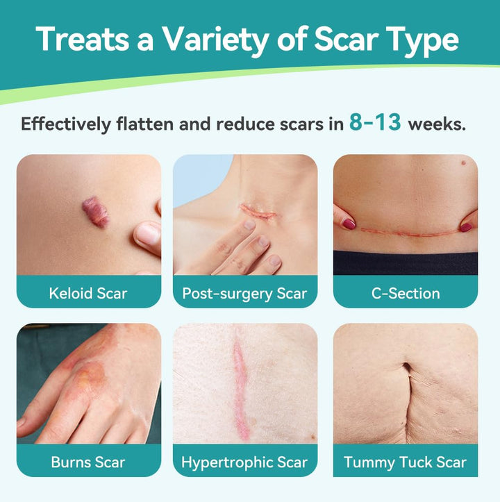 Dimora Medical Grade Silicone Scar Sheets -Ultra Soft Silicone Scar Tape (1.6”x60 Roll), Hypoallergenic Scar Removal Treatment for Surgical Scars, C Section, Tummy Tuck, Keloid Treatment