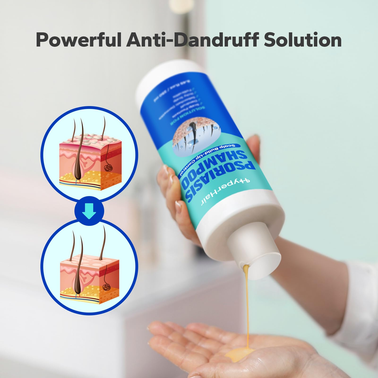 HyperHair Psoriasis Shampoo (8.45 Fl Oz), Medicated Shampoo with Salicylic Acid & Coconut Oil for Scalp Psoriasis, Seborrheic Dermatitis, Folliculitis & Dandruff, Anti-Itch, Flake-Free