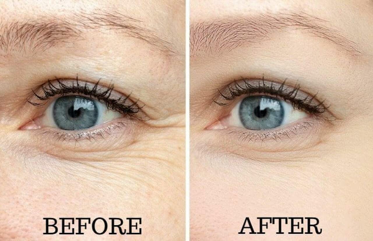 Osmotics Cosmeceuticals Eye Surgery Under Eye Rejuvenator, .5 oz.