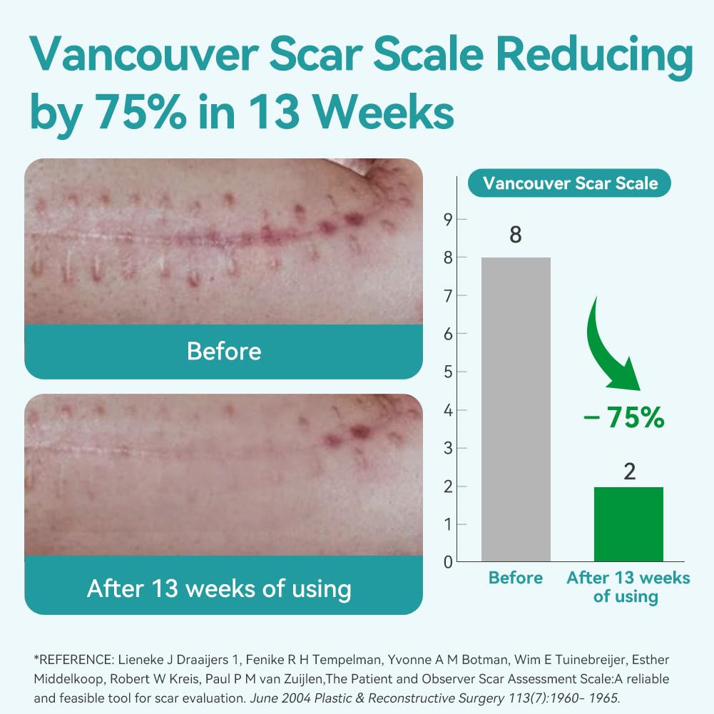 Dimora Medical Grade Silicone Scar Sheets -Ultra Soft Silicone Scar Tape (1.6”x60 Roll), Hypoallergenic Scar Removal Treatment for Surgical Scars, C Section, Tummy Tuck, Keloid Treatment