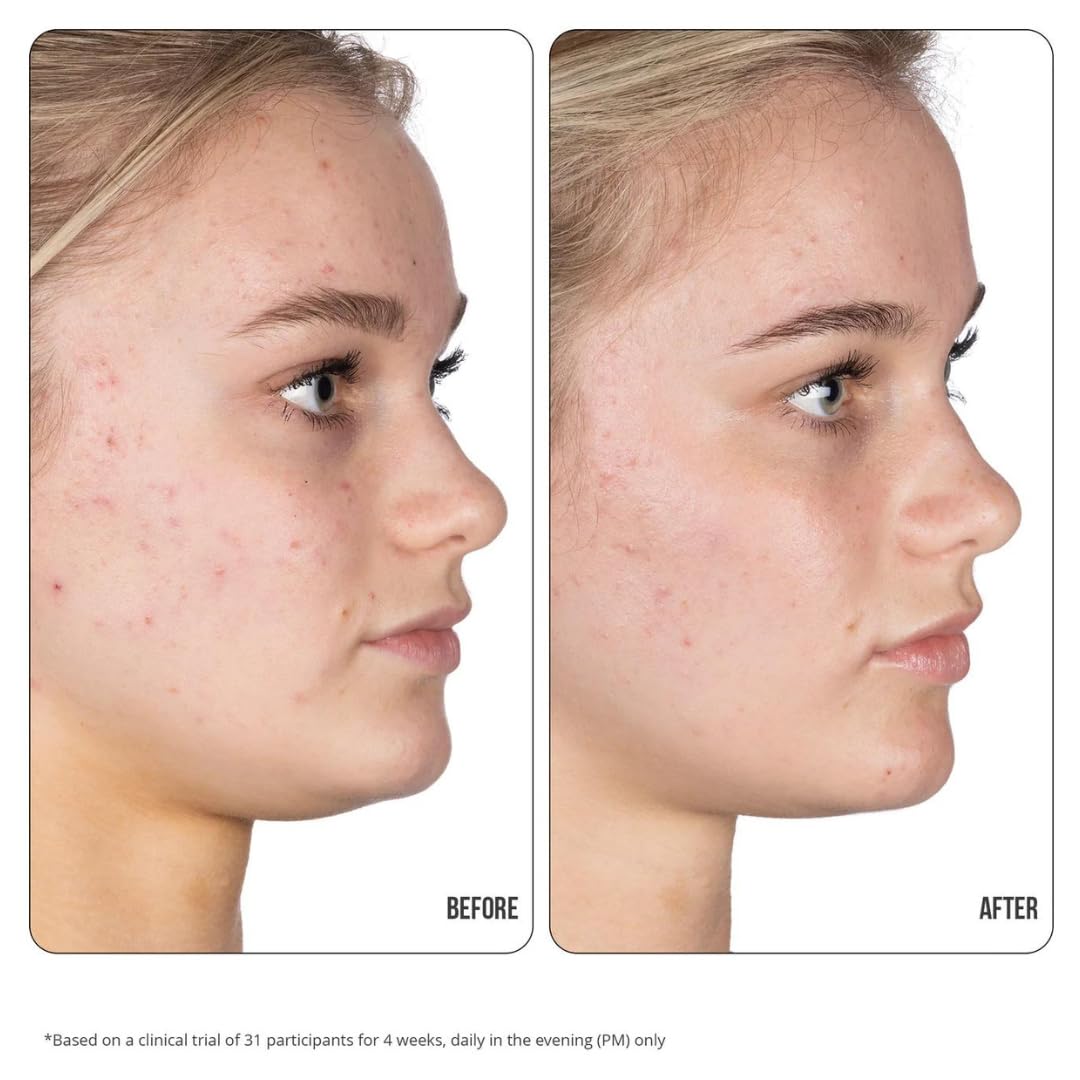 Nip+Fab Retinol Fix Blemish Gel Treatment 10% Complex, 0.5 fl. oz., 0.1% Ensapsulated Pure Retinol, 2% Niacinamide, 2% Trivalin, 0.5% Salicylic Acid to Target Blemishes, Dark Spots and Pore Size