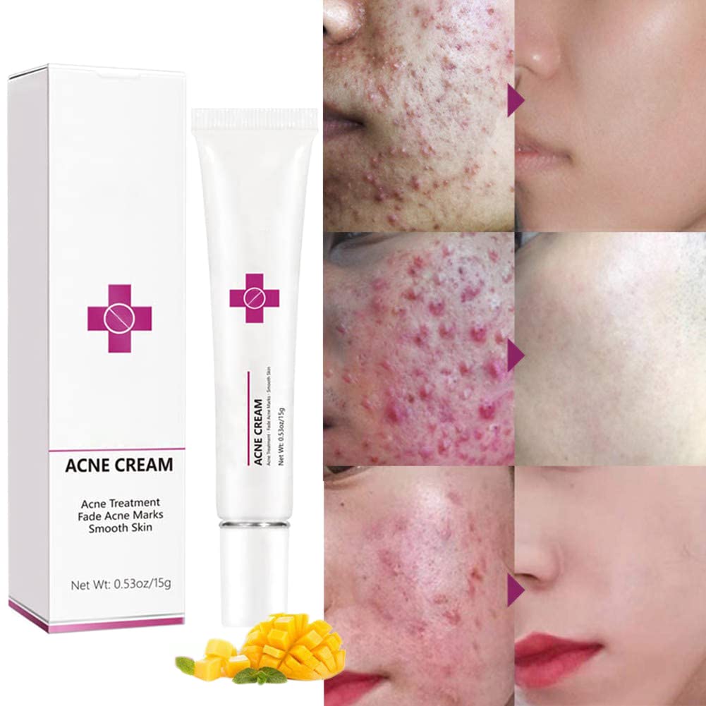 Acne Cream Pimple Cream for Face, Oil Control Pimple Remover Cream Get Rid of Pimples Fast,for Oily and Acne Prone Skin, Cruelty Free, Crema para espinillas en la cara