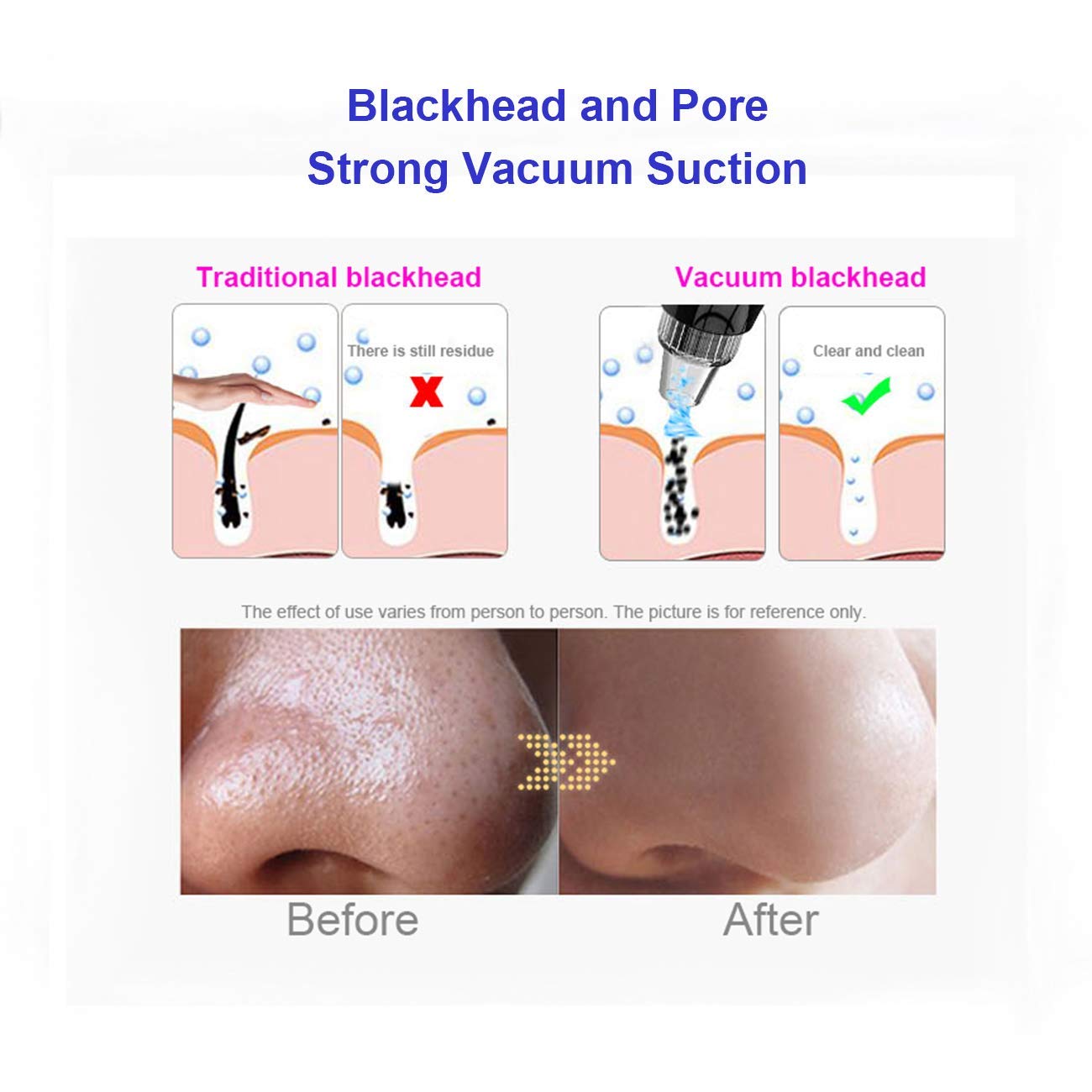 Blackhead Remover Pore Vacuum, Electric Blackhead Vacuum Cleaning Tool with 3 IPL Beauty Lamps & 6 Suction Heads - Pore Extractor, Facial Acne Comedone Cleaner for Women & Men